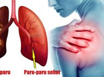 Cara mencegah penyakit paru-paru