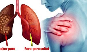 Cara mencegah penyakit paru-paru