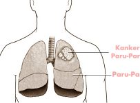 Kanker paru-paru dalam tubuh manusia